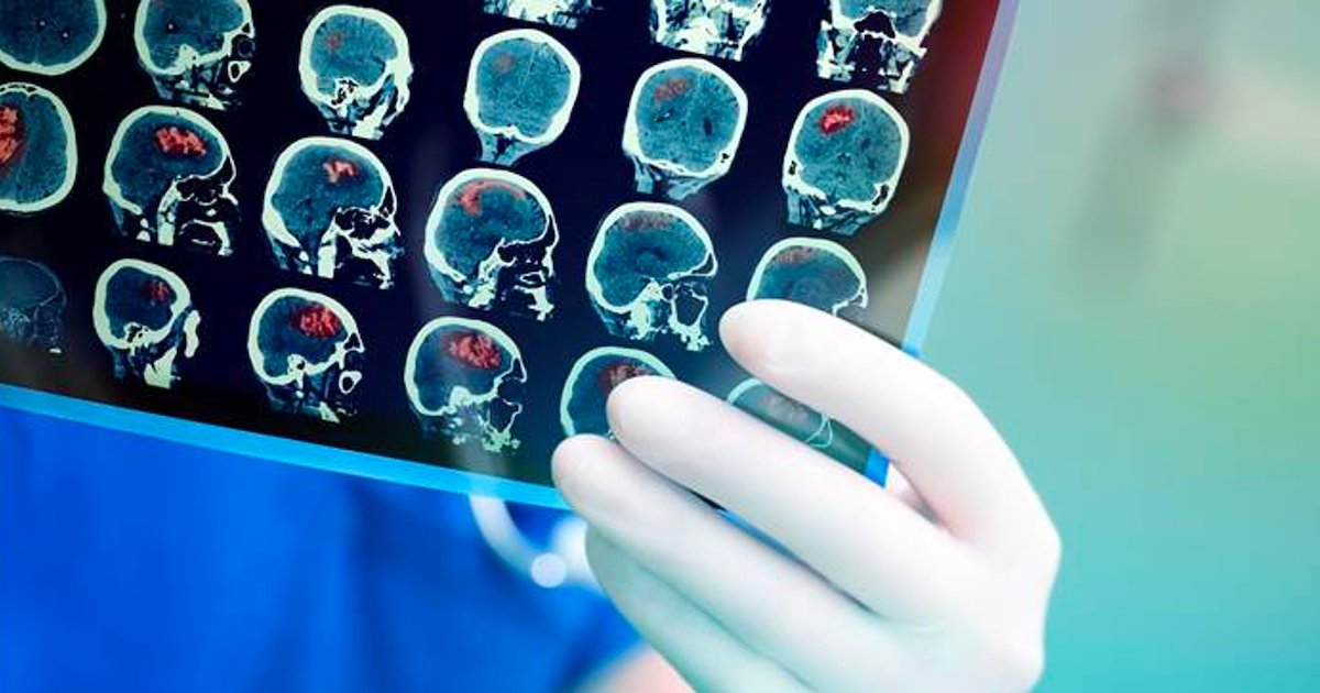 tumeur cerveau.png?resize=412,232 - Une femme a récolté plus de 70 000 euros en ligne pour faire retirer sa tumeur au cerveau